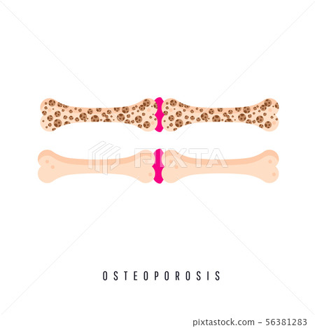Medical problem of osteoporosis disease 56381283