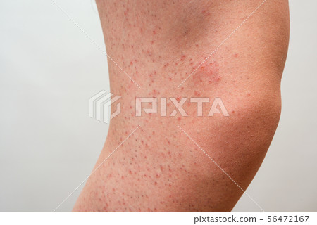 失去剃刀後變紅的男子腿 56472167