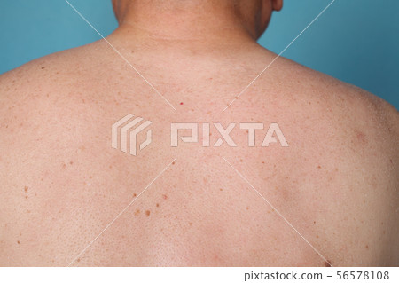 Dry skin symptoms 56578108