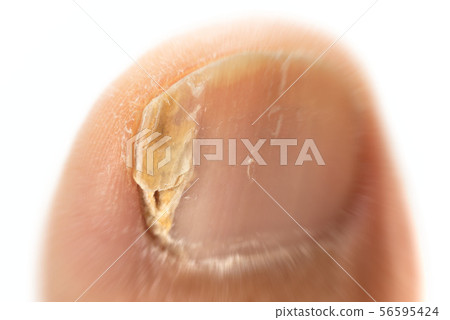 指甲運動員的腳 56595424