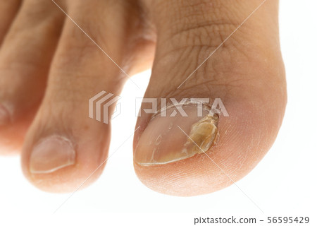 Nail athlete's foot 56595429