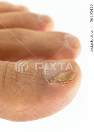 Nail athlete's foot 56595430