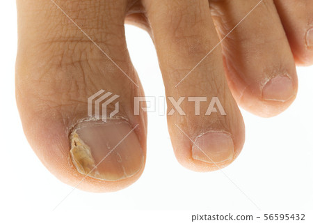 Male toenail onychomycosis 56595432