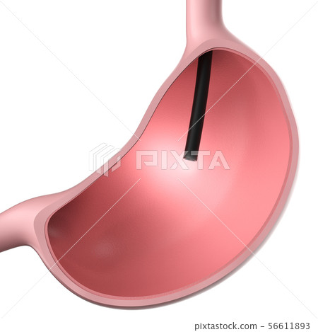 endoscope in stomach endoscope in stomach 56611893