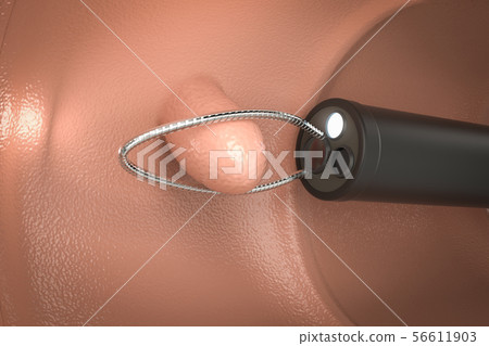 endoscope remove colonic polyp 56611903