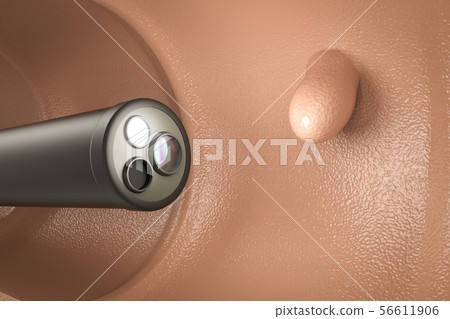 Colonoscopy technology concept 56611906