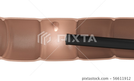 Colonoscopy technology concept 56611912