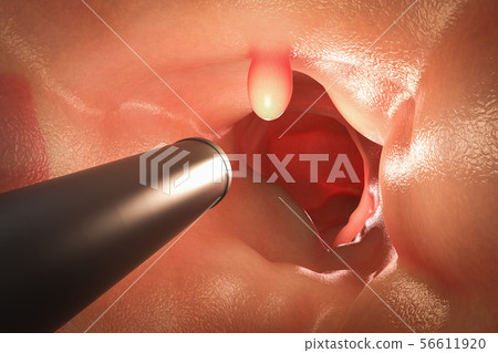 Colonoscopy technology concept 56611920