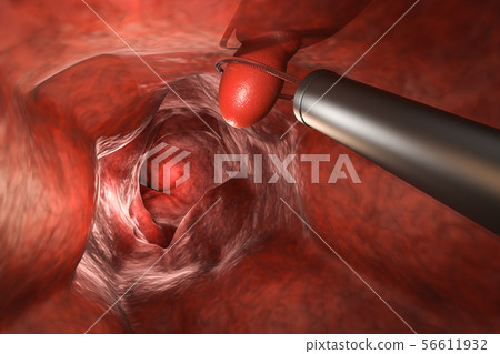 endoscope remove colonic polyp 56611932