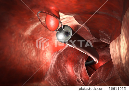 endoscope remove colonic polyp 56611935