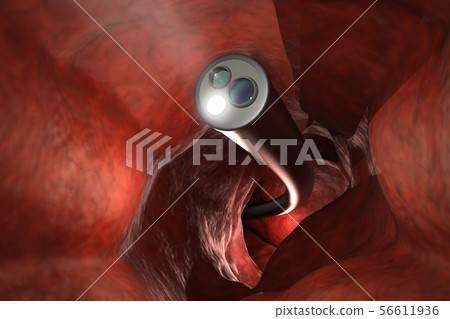 Colonoscopy technology concept 56611936
