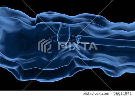 endoscope remove colonic polyp 56611941