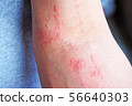 Dermatitis 2 56640303