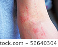 Dermatitis 3 56640304