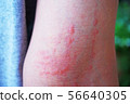 Dermatitis 1 56640305