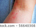Dermatitis 4 56640308
