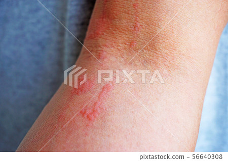 Dermatitis 4 56640308