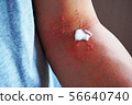 Dermatitis and ointment 9 56640740