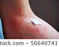 Dermatitis and ointment 8 56640741