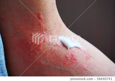 Dermatitis and ointment 8 56640741