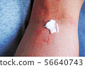 Dermatitis and ointment 5 56640743