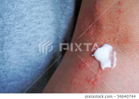 Dermatitis and ointment 6 56640744