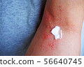 Dermatitis and ointment 3 56640745