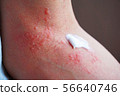 Dermatitis and ointment 4 56640746