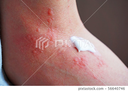 Dermatitis and ointment 4 56640746