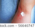 Dermatitis and ointment 2 56640747
