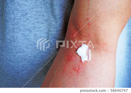 Dermatitis and ointment 2 56640747