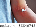Dermatitis and ointment 10 56640748