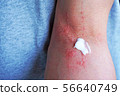 Dermatitis and ointment 1 56640749