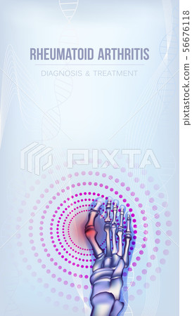 Rheumatoid arthritis bones concept 56676118