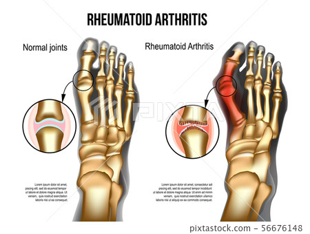 Rheumatoid arthritis Bones the of foot 56676148