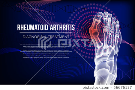 Rheumatoid arthritis Bones the of foot Rheumatoid arthritis Bones the of foot 56676157