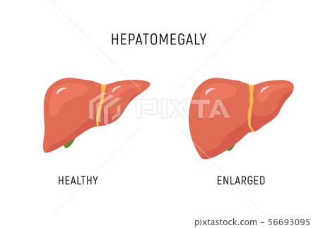 Enlarged liver hepatomegaly disease icon. Human liver health illustration anatomy design 56693095