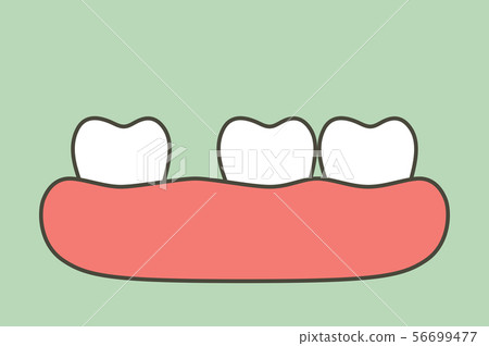 spacing teeth (diastema) spacing teeth (diastema) 56699477