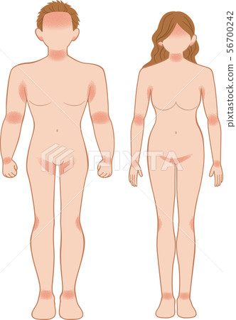 Ashemo / Eczema Full Body Front and Male Ashemo / Eczema Full Body Front and Male 56700242