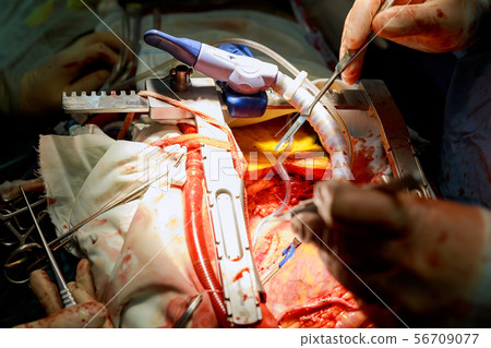 A surgeon performs coronary artery bypass grafting A surgeon performs coronary artery bypass grafting 56709077