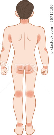 Ashemo / Eczema Full body behind men 56715196