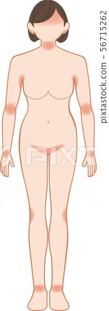Ashemo / Eczema Full Body Front Female Ashemo / Eczema Full Body Front Female 56715262