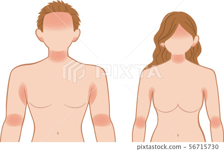 Ashemo /濕疹上身,男女 Ashemo /濕疹上身,男女 56715730