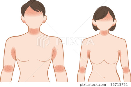 Ashemo / Eczema upper body, men and women 56715731