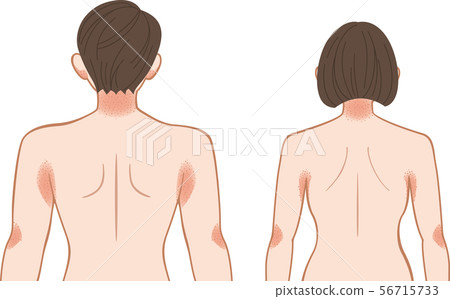 Ashemo /濕疹上身背後的男女 56715733