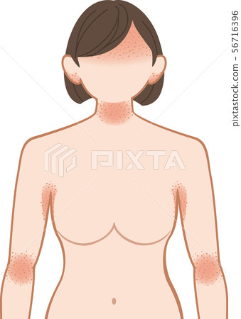 Ashemo / Eczema Upper Body Female Ashemo / Eczema Upper Body Female 56716396