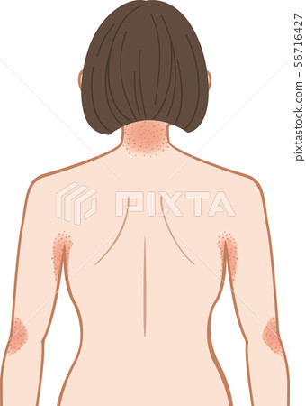 Ashemo / Eczema upper body behind woman 56716427
