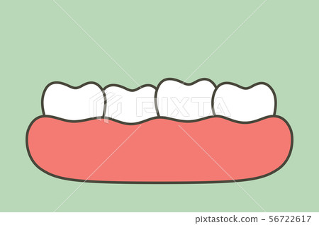 crowding teeth (malocclusion) 56722617