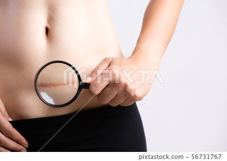 Closeup of woman showing on her belly dark scar Closeup of woman showing on her belly dark scar 56731767
