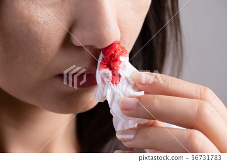 Nosebleed , a young woman suffering from nose 56731783